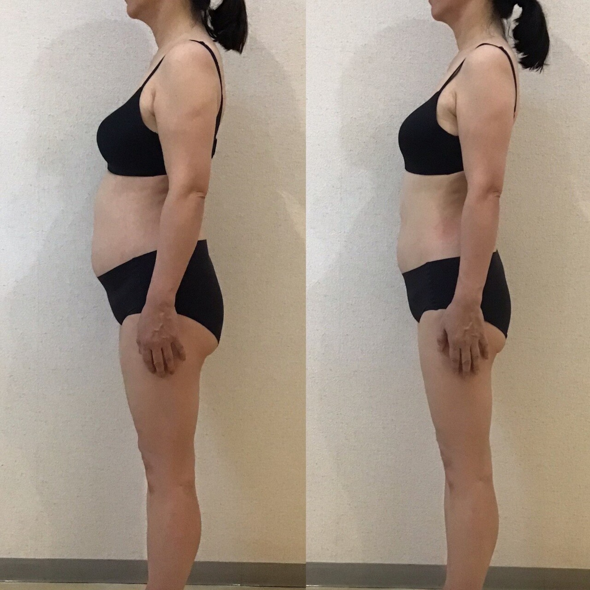 53歳　158cm｜岡崎市の痩身エステ施術例