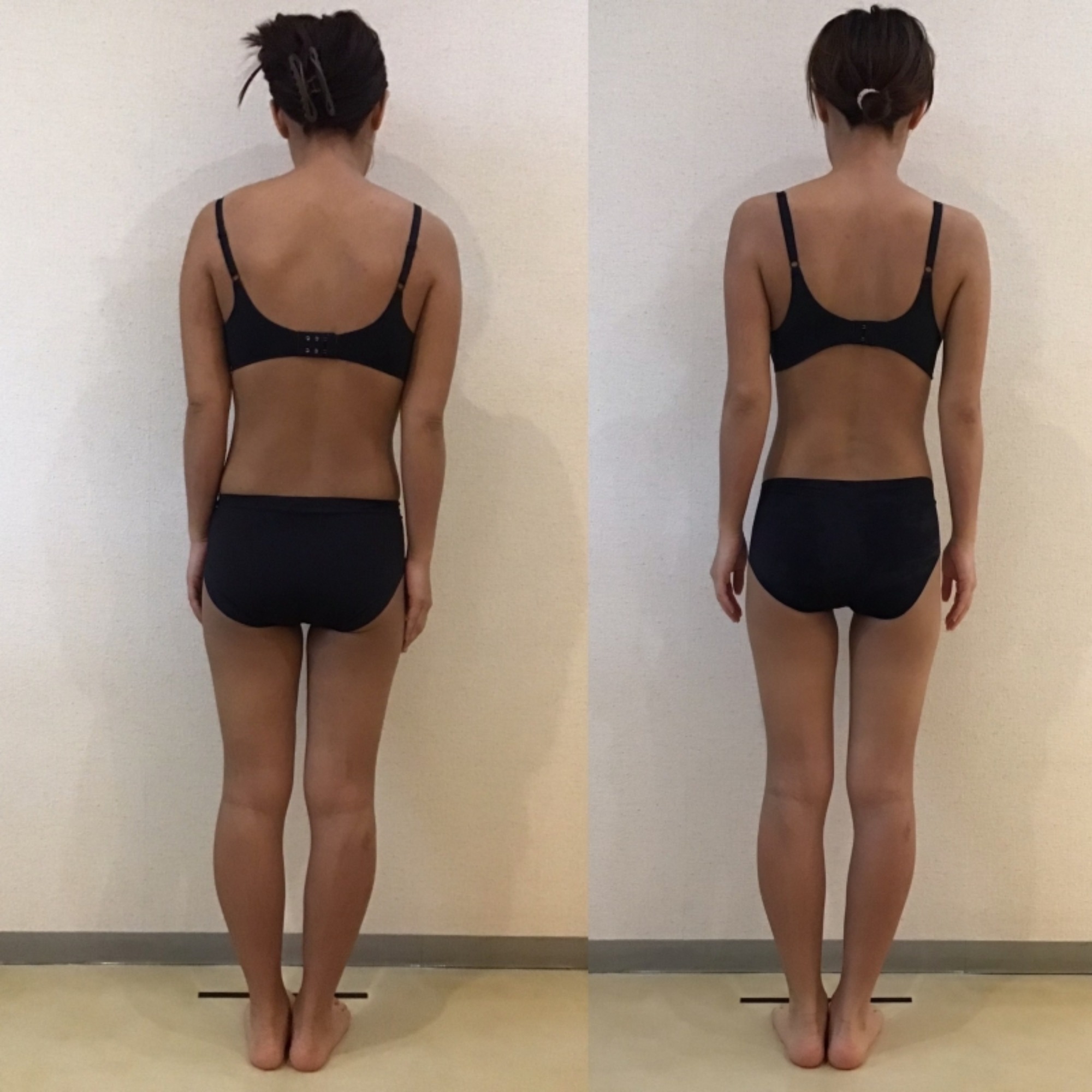 35歳　165cm｜岡崎市の痩身エステ施術例