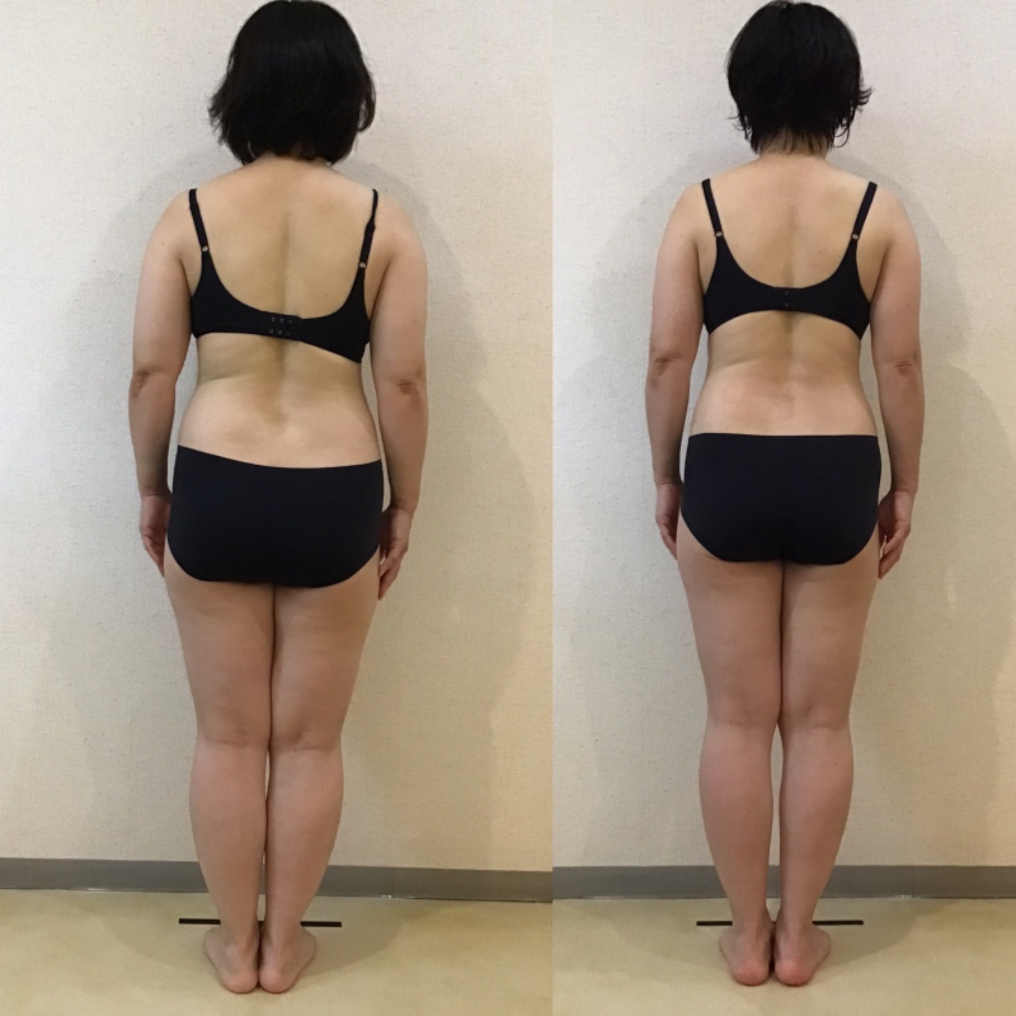 50歳　158cm｜岡崎市の痩身エステ施術例